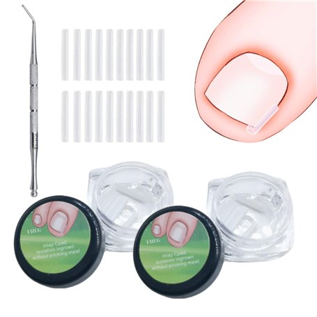 101 Pièces Bandes Correctrices d'Ongles Incarnés Kit