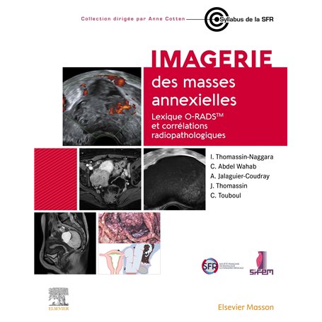 Imagerie des masses annexielles