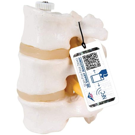 3B Scientific® Modèle de 3 Vertèbres Lombaires – Segment Vertébral Taille Réelle avec Disques Intervertébraux
