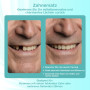 Prothèse Partielle Dentaire sur mesure - Dentier Provisoire, Prothese dentaire amovible et provisoire. Ajustement parfait et uti