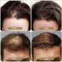 Fibre Capillaire, Poudre Densifiante Cheveux Homme Femme,Pour Épaissir les Cheveux en Secondes,Hair Building Fibres Pour Cheveux